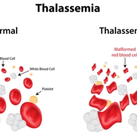 Làm thế nào để phát hiện bệnh thalassemia (tan máu bẩm sinh)?